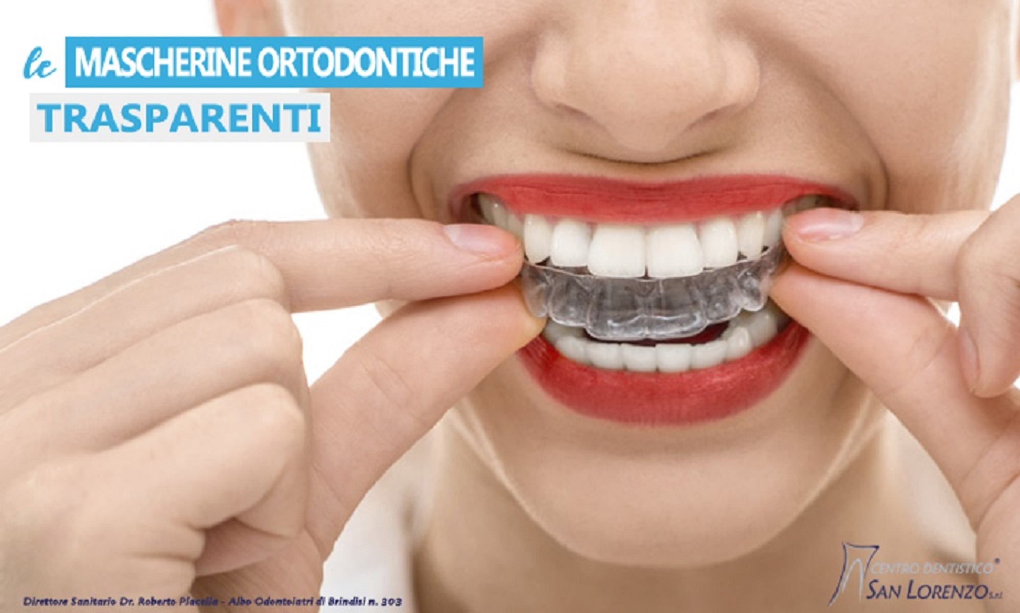 Ortodonzia Invisibile - le mascherine ortodontiche trasparenti per allineare i denti 